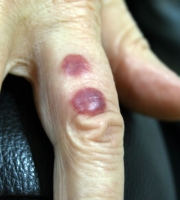 bed-bug-bite-on-finger