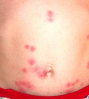bed-bug-bite-on-stomach-pictures