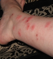 bed-bug-bites-leg