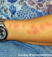 bed-bug-bites-picture-arms