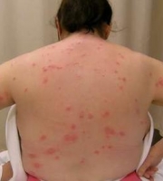 bed-bug-bites