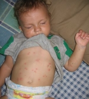 infant-baby-bed-bug-bites