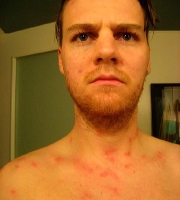 neck-chest-bed-bug-bites-pictures