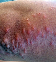 photo-bed-bug-bites-arm