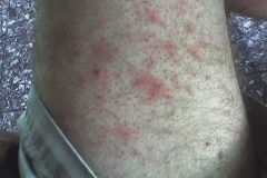 bed-bug-bites-rash