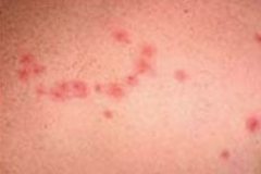 bed_bug_bites_appearance