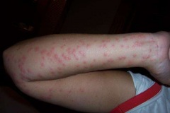 bed_bug_bites_arm