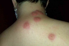 bedbug-bites-neck