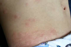 bedbug-bites-on-baby