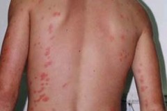 bedbug-bites-on-backs