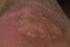 bedbug-rash