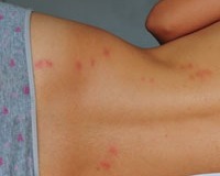 bedbug_bites_back