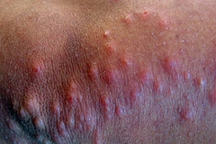 bedbug_bites_on_arms