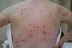 bedbug_bites_on_back