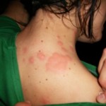 Bed-Bug-Bites-on-victims-neck