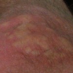 allergic-reaction-on-skin-from-Bed-bug-bites-