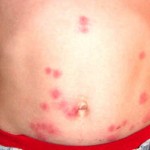 painful-bed-bug-bites-on-stomach