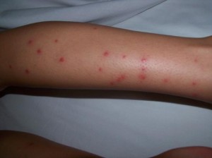 bed-bug-bites