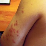 bed-bug-bites-on-arm