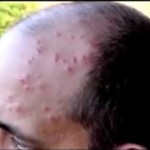 bed-bug-bites-on-victims-head