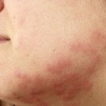 bed-bug-bites-on-victims-jaw