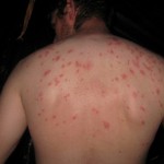 bed-bug-victim-with-bites-all-over-back