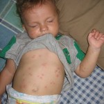 infant-suffering-with-bed-bug-bites
