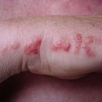 reaction-on-hand-after-bed-bug-bites