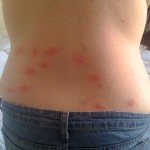 sore-bed-bug-bites-on-lower-back