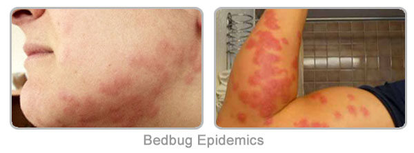Bedbug Epidemics