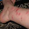 Bedbug Symptums