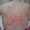 Bedbug Symptums