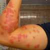 Bed Bug Transnmit Diseases